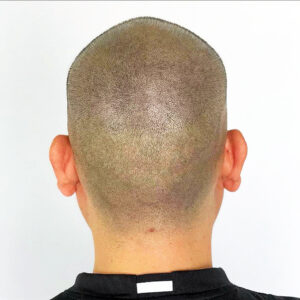 tricopigmentation